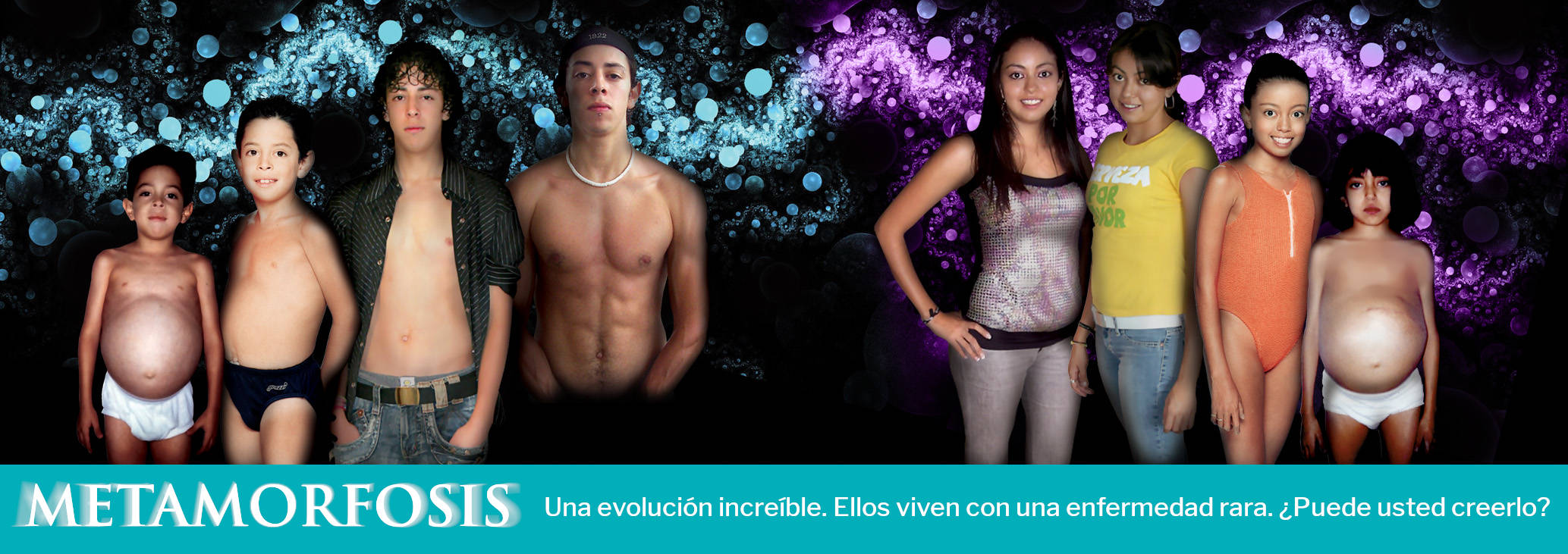 METAMORFOSIS. Una evolución increíble. Ellos son personas que viven con una enfermedad rara. ¿Puede usted creelo?